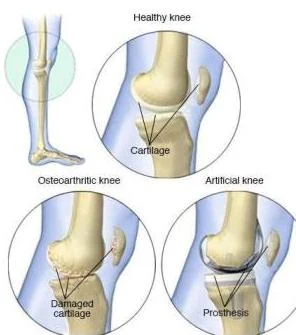 Diagrams illustrating a healthy knee, an osteoarthritic knee with damaged cartilage, and an artificial knee with a prosthesis.