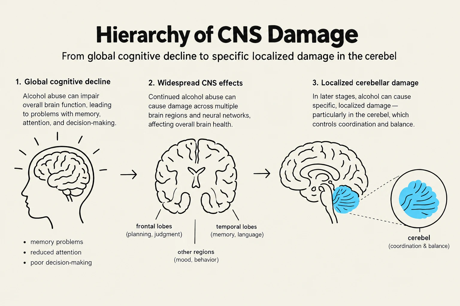 This diagram illustrates the progression of Central Nervous System (CNS) damage, starting from global cognitive decline and moving towards specific localized damage, particularly in the cerebellum, often associated with alcohol abuse.