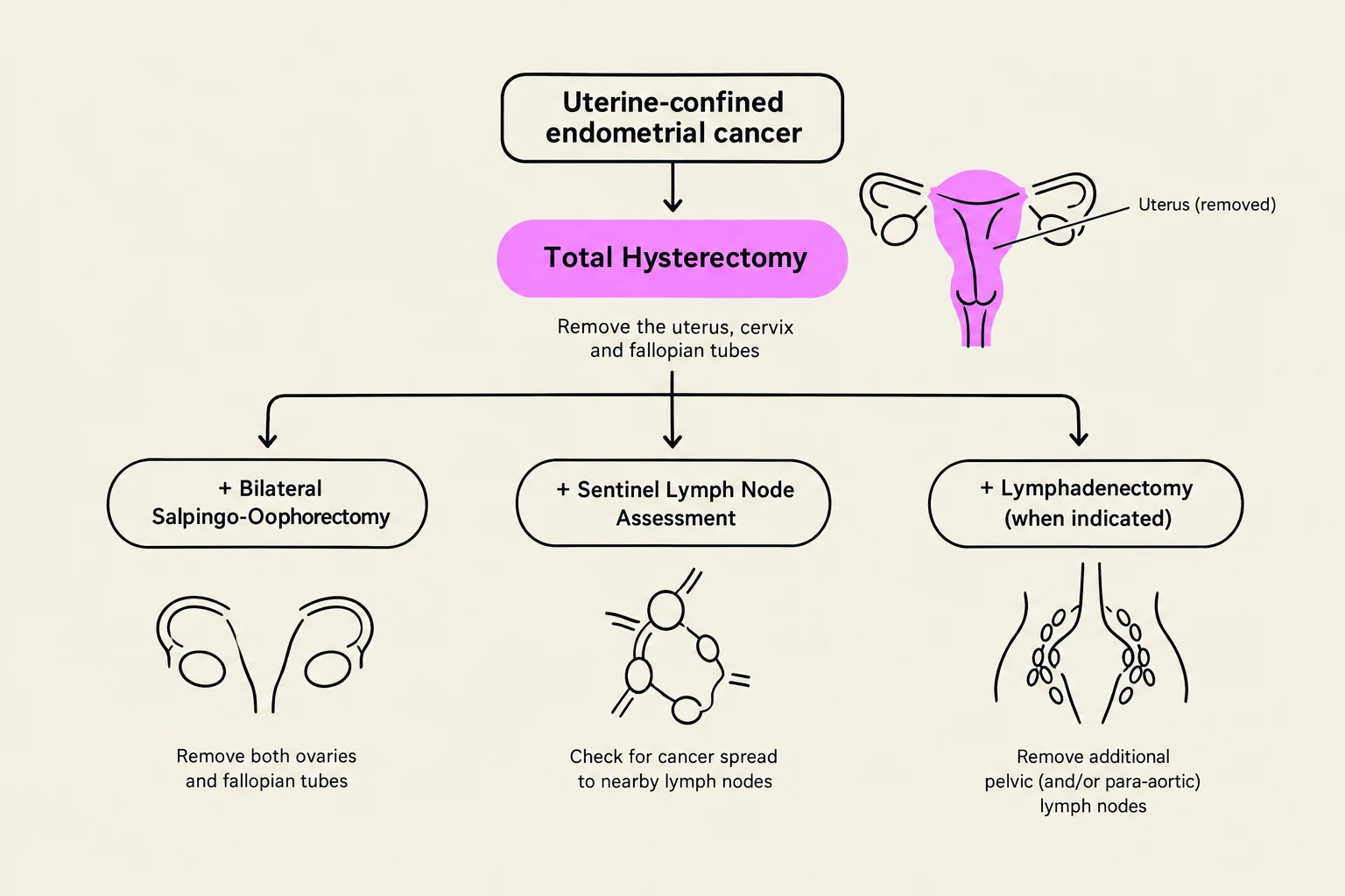 This diagram illustrates the treatment options for uterine-confined endometrial cancer, including total hysterectomy, bilateral salpingo-oophorectomy, sentinel lymph node assessment, and lymphadenectomy.