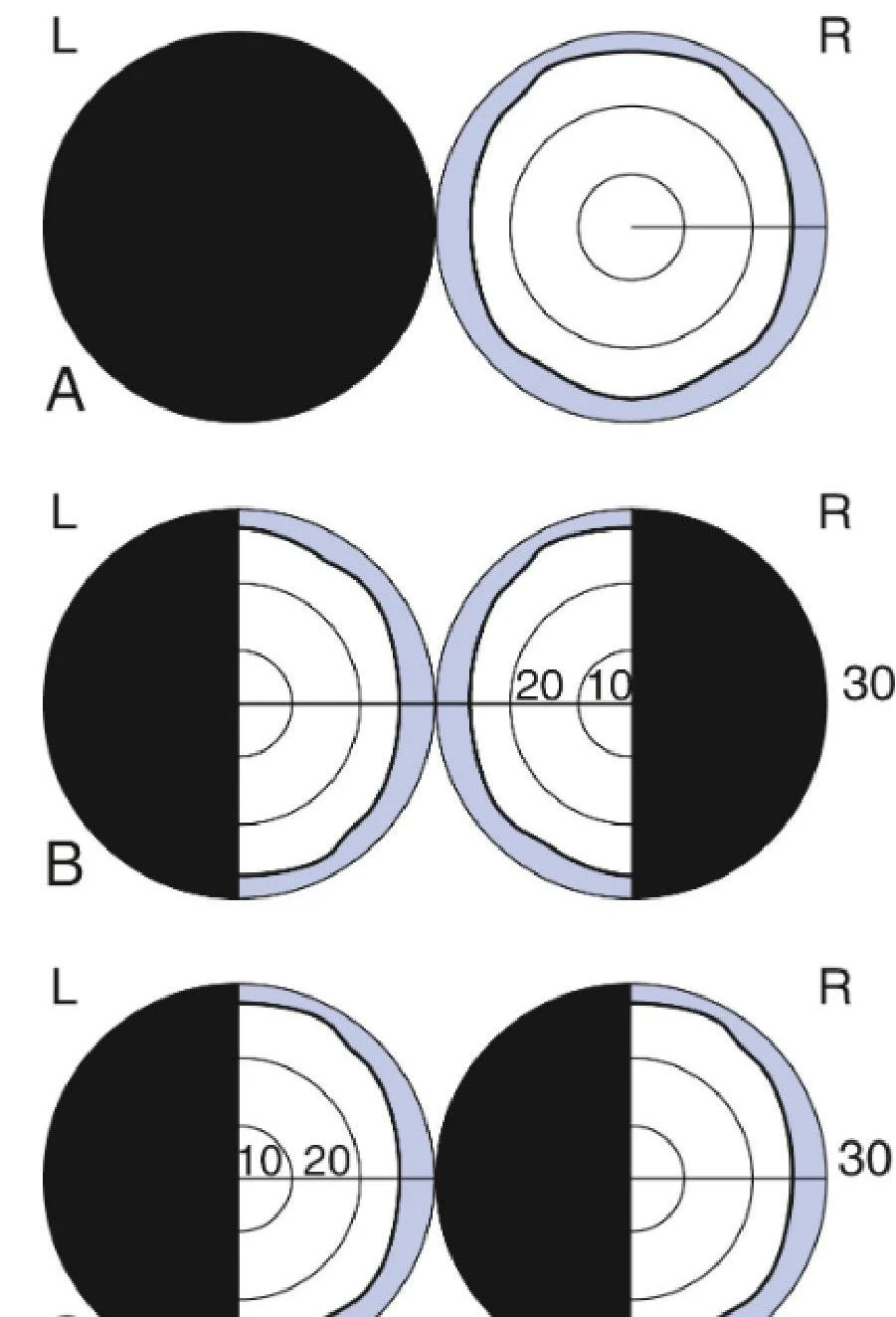 Diagrams illustrating visual field defects in the left (L) and right (R) eyes, labeled A, B, and C, with numerical scales indicating degrees of visual field.