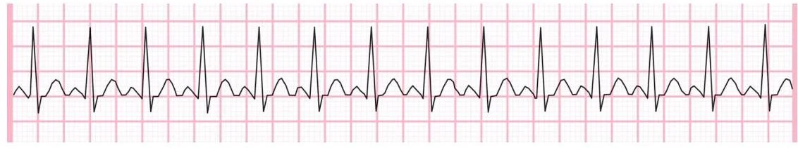 A representation of a normal electrocardiogram (ECG) showing the electrical activity of the heart.