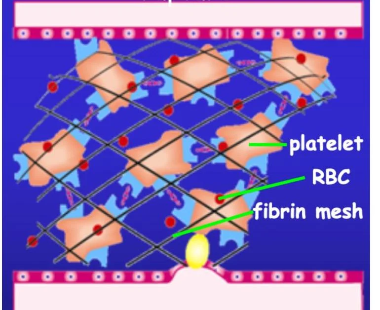 Diagram illustrating a blood clot formation with platelets, red blood cells (RBC), and a fibrin mesh.