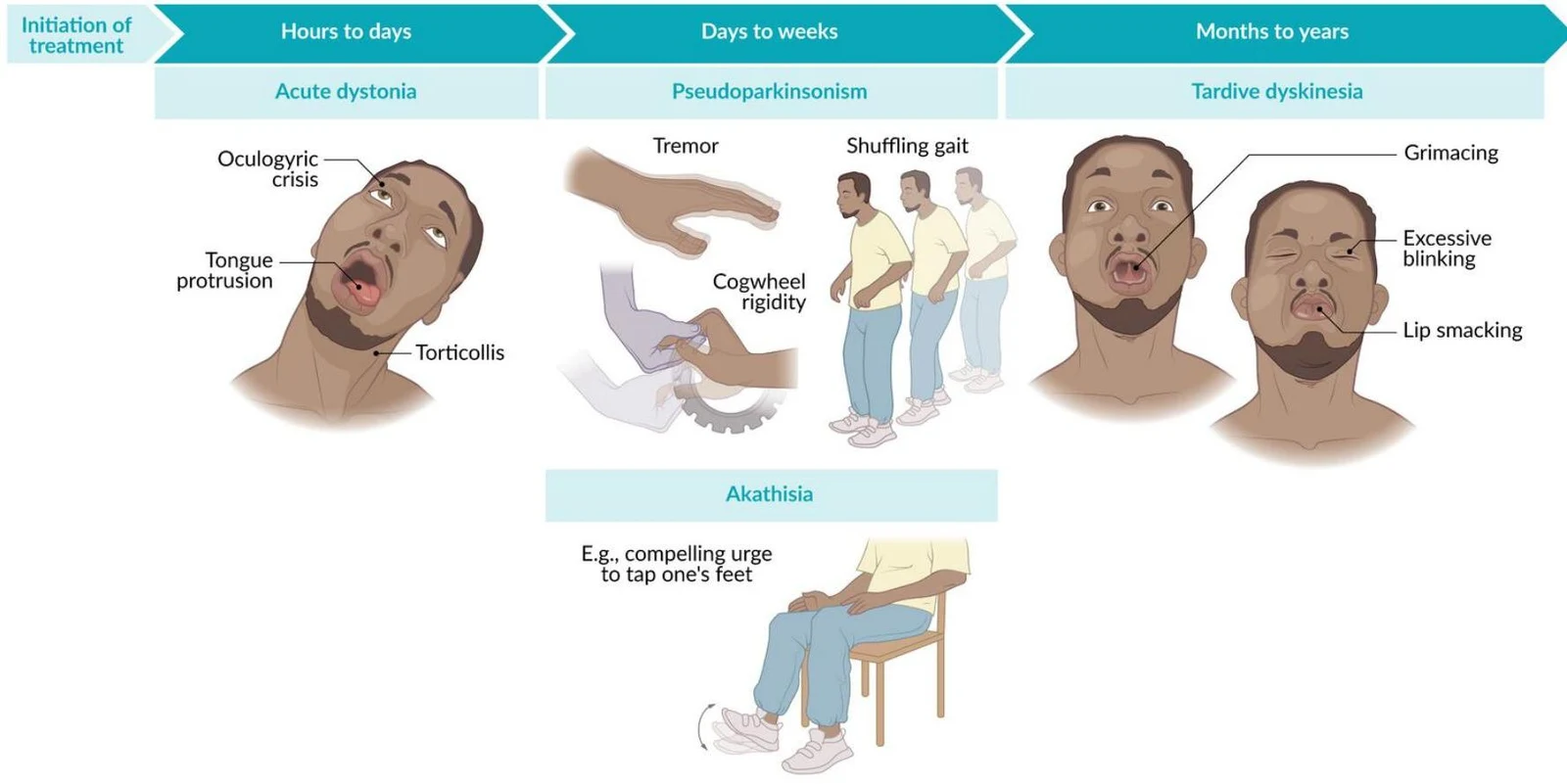 This illustration depicts various movement disorders that can occur as side effects of certain medications, categorized by the typical onset time after initiation of treatment: acute dystonia, pseudoparkinsonism, tardive dyskinesia, and akathisia.