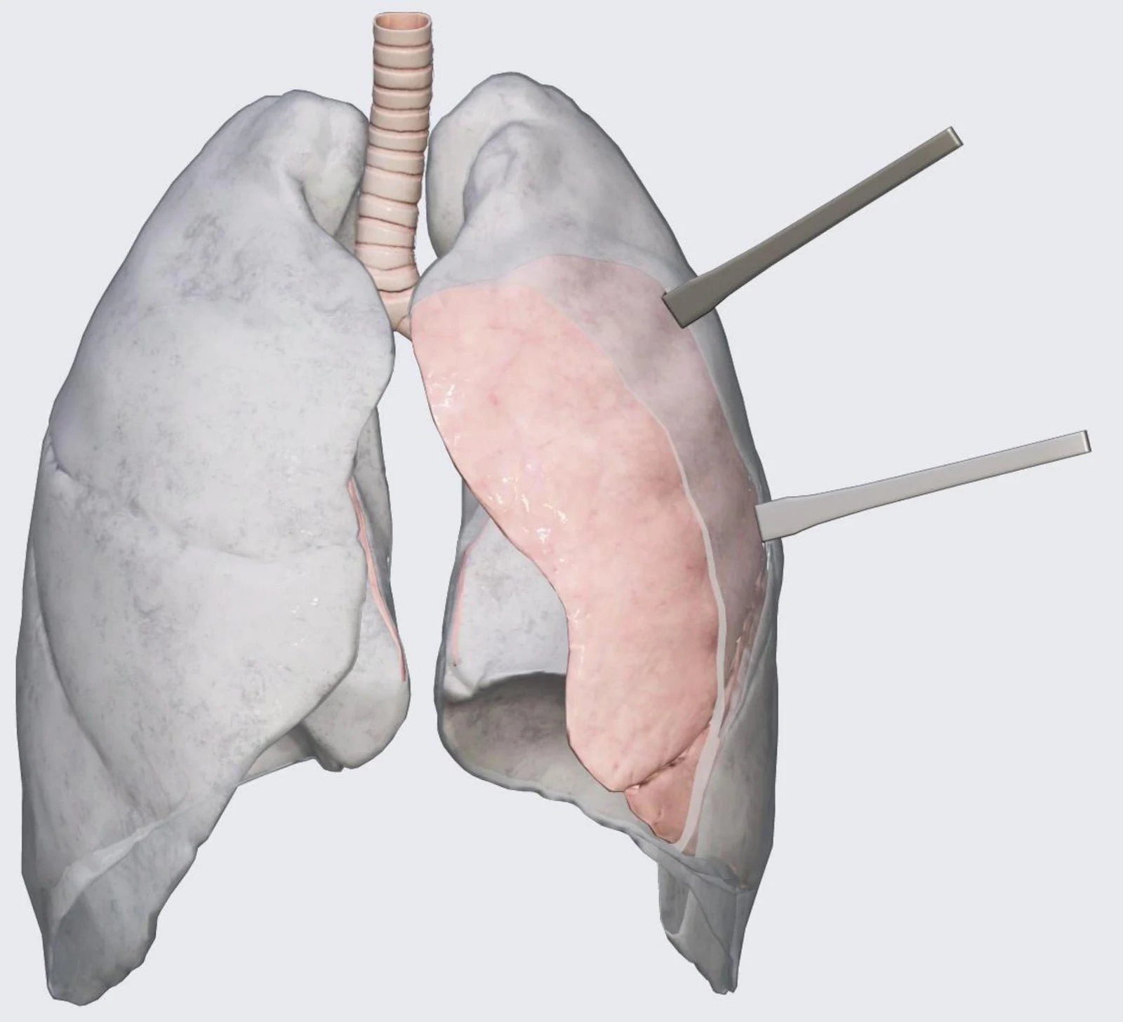 An illustration of the human lungs and trachea, with two probes inserted into the right lung.