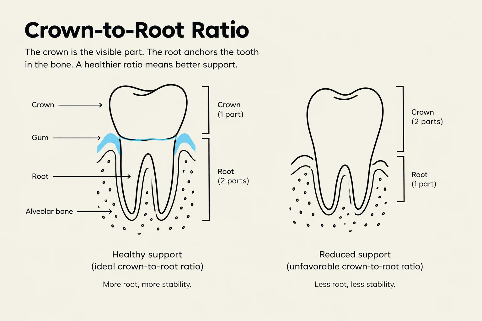 This diagram illustrates the crown-to-root ratio in teeth, comparing a healthy tooth with ideal support (1 part crown to 2 parts root) to a tooth with reduced support (2 parts crown to 1 part root), highlighting the importance of root length for stability.