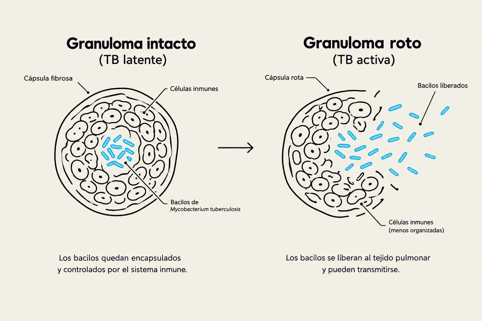 Diagram illustrating the difference between a latent TB granuloma (intact) and an active TB granuloma (broken), showing encapsulated bacilli versus released bacilli.