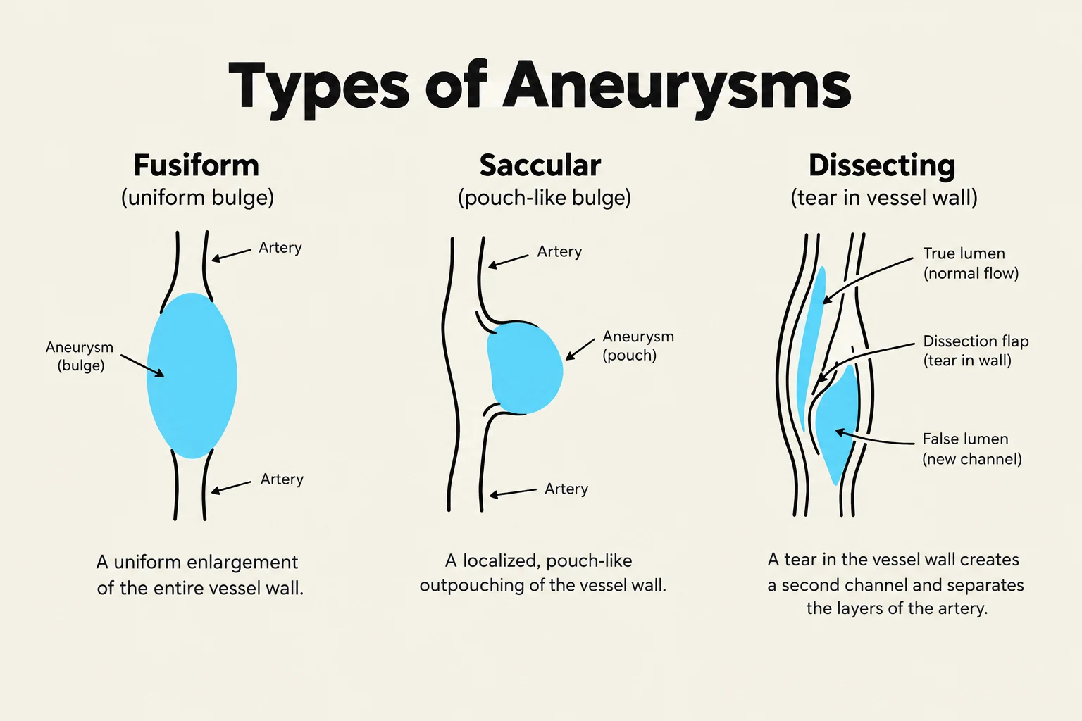 Diagrams illustrating three types of aneurysms: Fusiform, Saccular, and Dissecting, with explanations of their characteristics and formation.