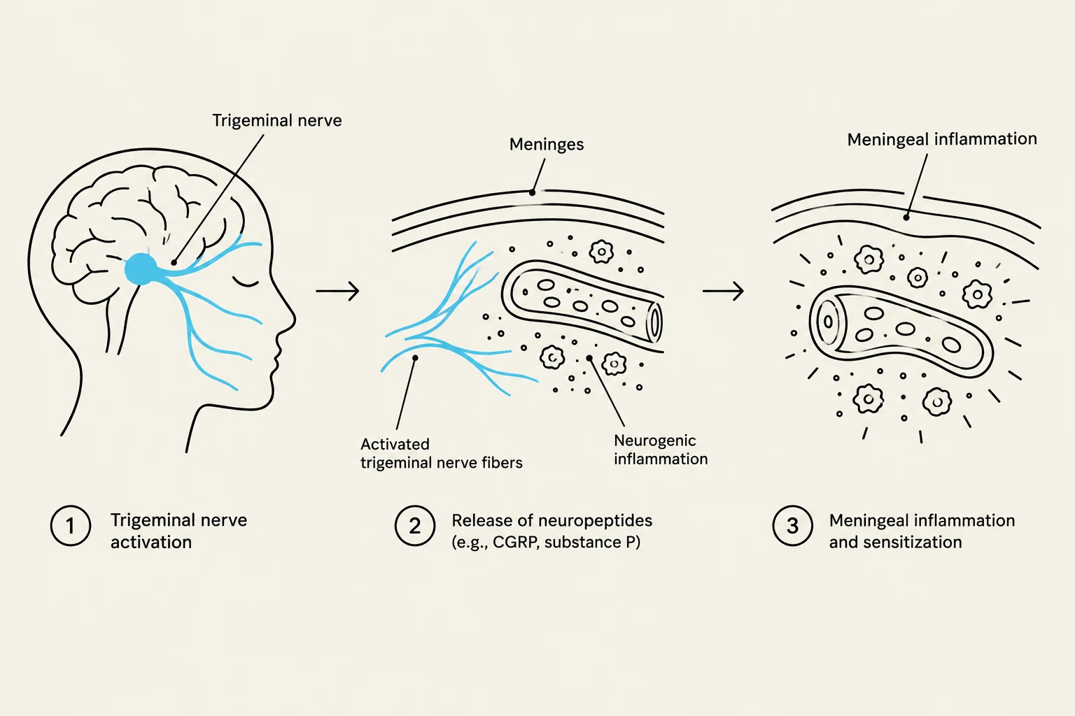 Diagram illustrating the process of trigeminal nerve activation leading to meningeal inflammation and sensitization.