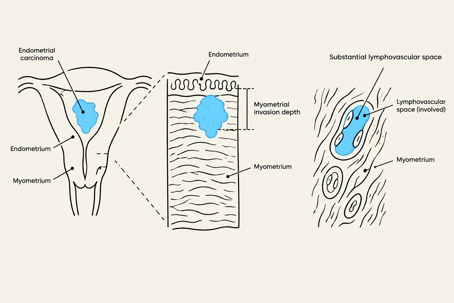 Diagram illustrating endometrial carcinoma invasion into the myometrium and lymphovascular space.