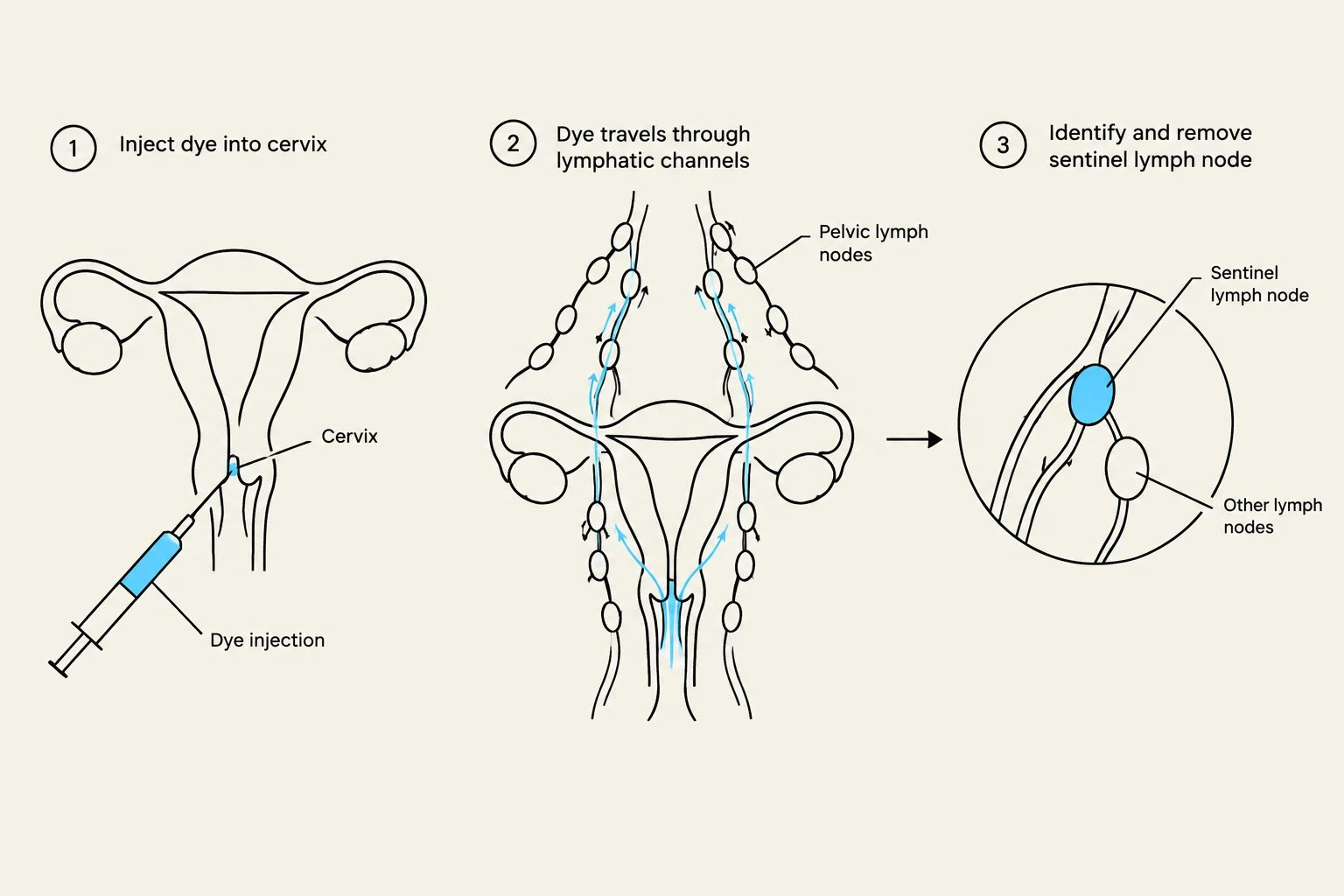 Diagram illustrating the sentinel lymph node biopsy procedure for cervical cancer, showing dye injection into the cervix, its travel through lymphatic channels, and the identification and removal of the sentinel lymph node.