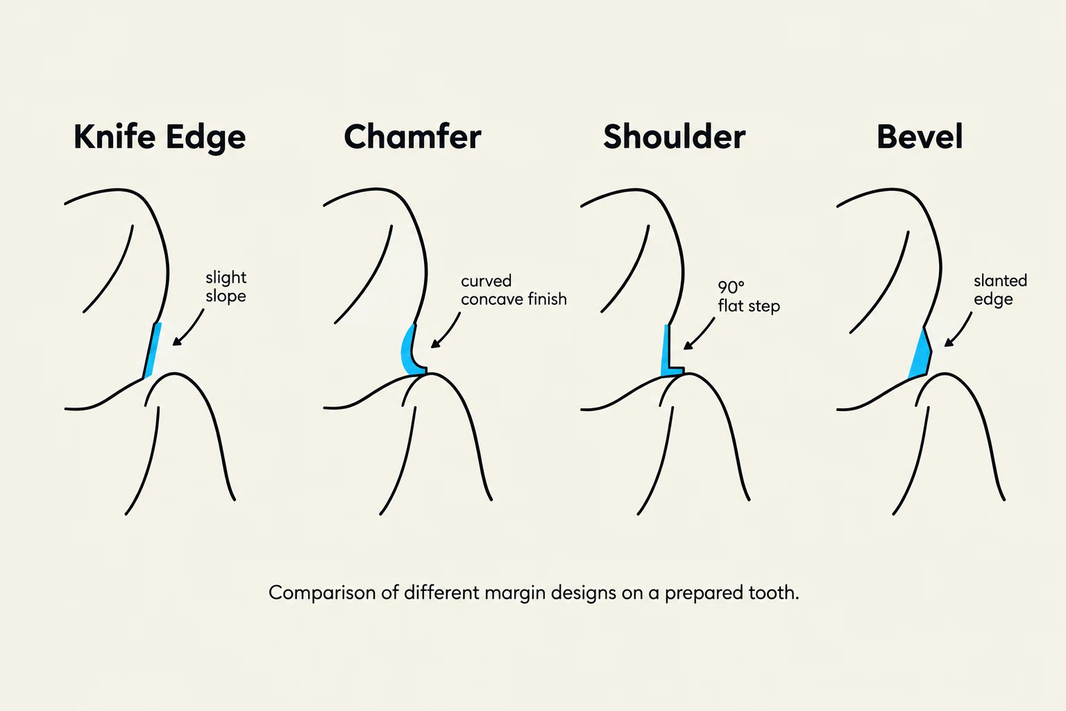 Comparison of different margin designs on a prepared tooth.