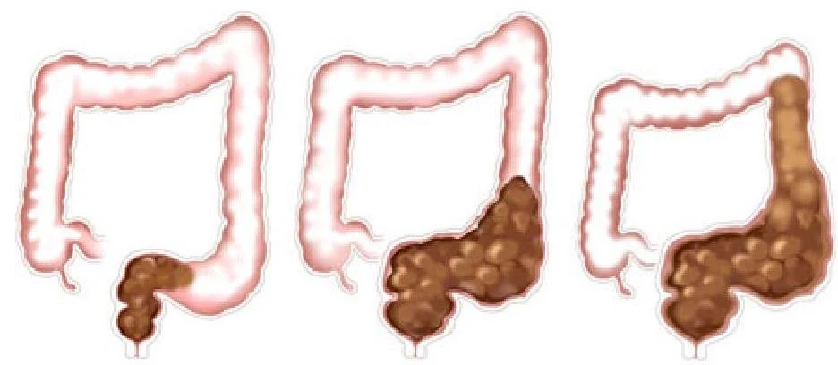 Diagram illustrating the progression of fecal impaction in the colon.
