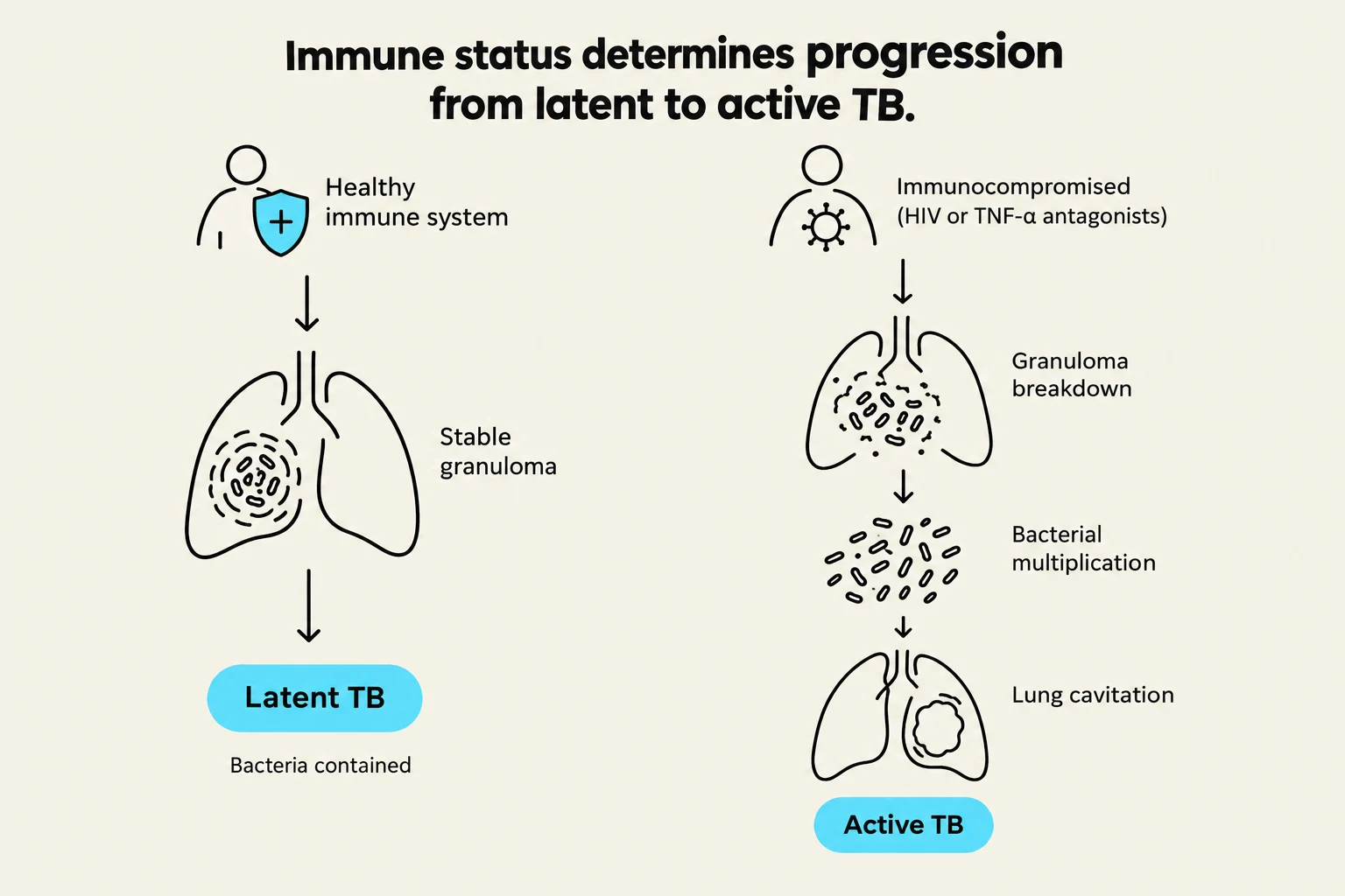 This diagram illustrates how immune status influences the progression from latent to active tuberculosis. A healthy immune system can contain the bacteria, leading to latent TB. In contrast, an immunocompromised state can cause granuloma breakdown, bacterial multiplication, and lung cavitation, resulting in active TB.