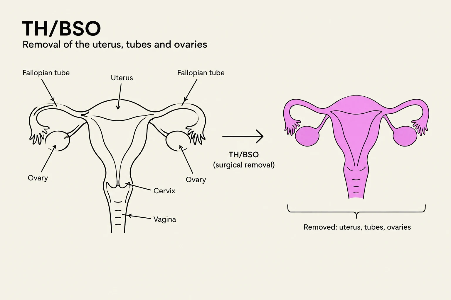 Diagram illustrating the surgical procedure TH/BSO (Total Hysterectomy/Bilateral Salpingo-Oophorectomy), which involves the removal of the uterus, fallopian tubes, and ovaries.