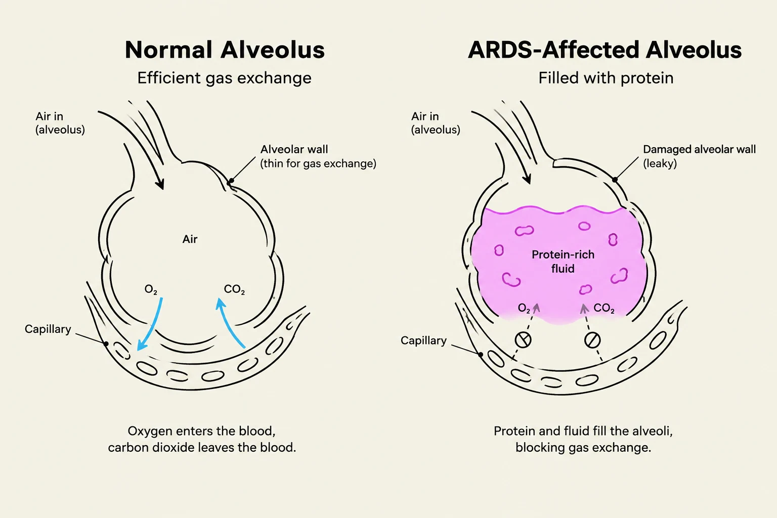 Comparison of a normal alveolus, responsible for efficient gas exchange, with an ARDS-affected alveolus filled with protein-rich fluid that blocks gas exchange.