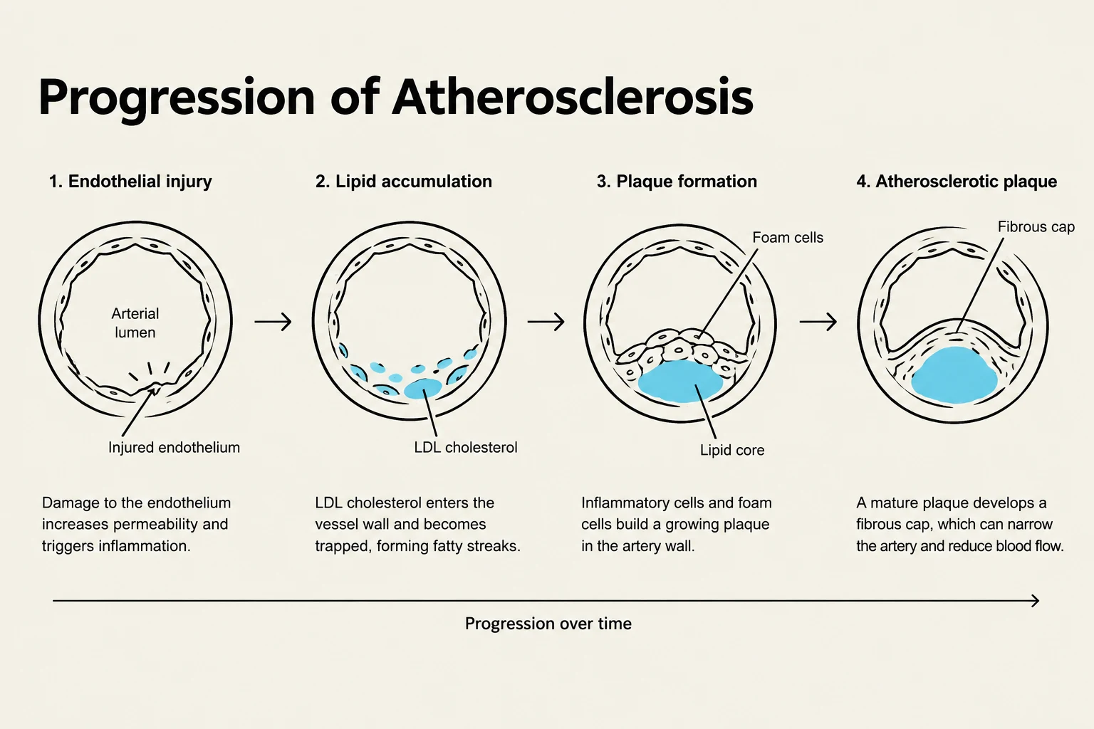 This diagram illustrates the progression of atherosclerosis, a condition characterized by the buildup of plaque in arteries. It shows the stages from endothelial injury and lipid accumulation to plaque formation and the development of an atherosclerotic plaque that can narrow the artery and impede blood flow.
