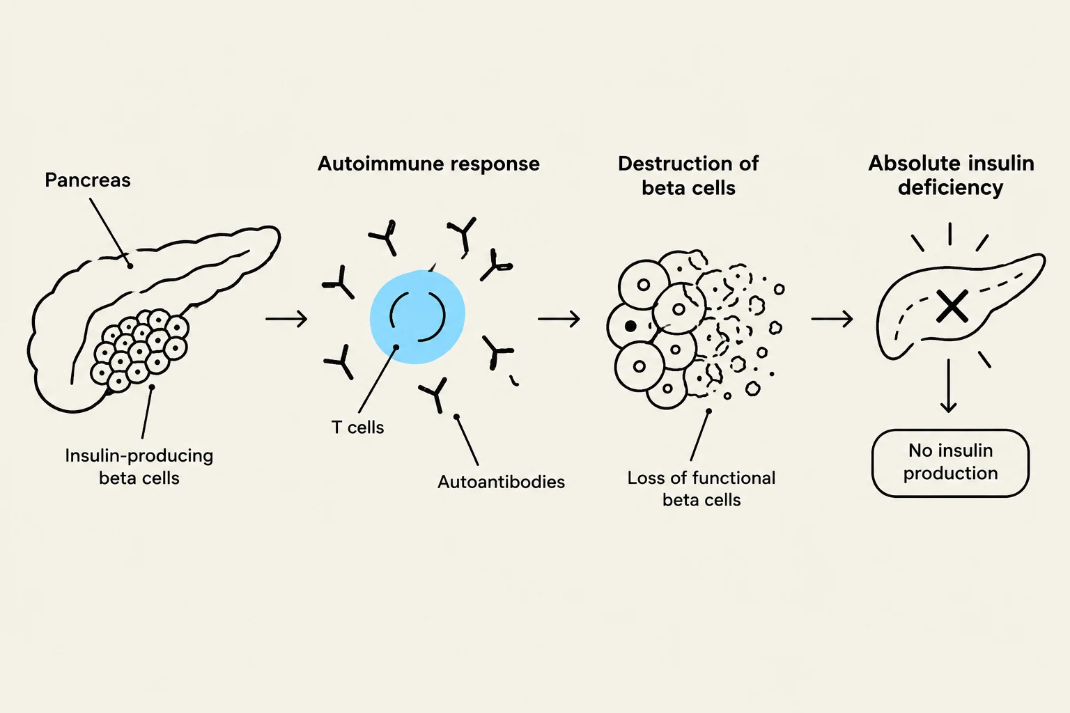 Diagram illustrating the autoimmune process leading to type 1 diabetes, where the immune system attacks and destroys insulin-producing beta cells in the pancreas, resulting in absolute insulin deficiency and no insulin production.