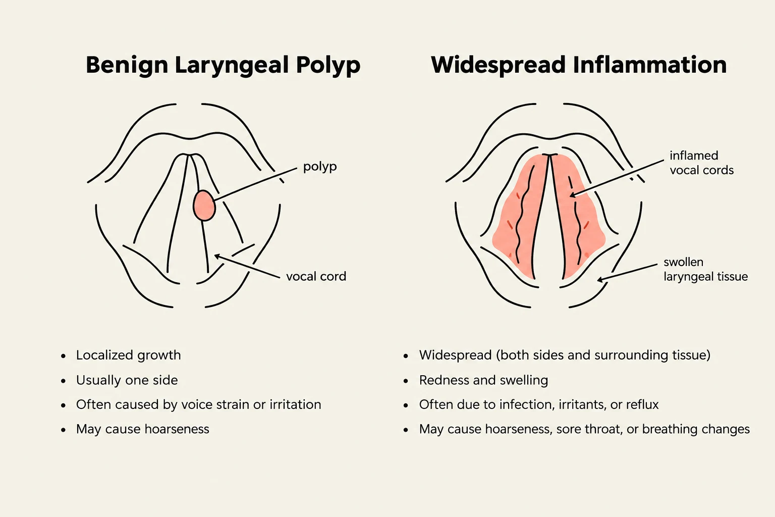Diagrams illustrating a benign laryngeal polyp and widespread inflammation of the vocal cords, with accompanying descriptions of their characteristics and causes.
