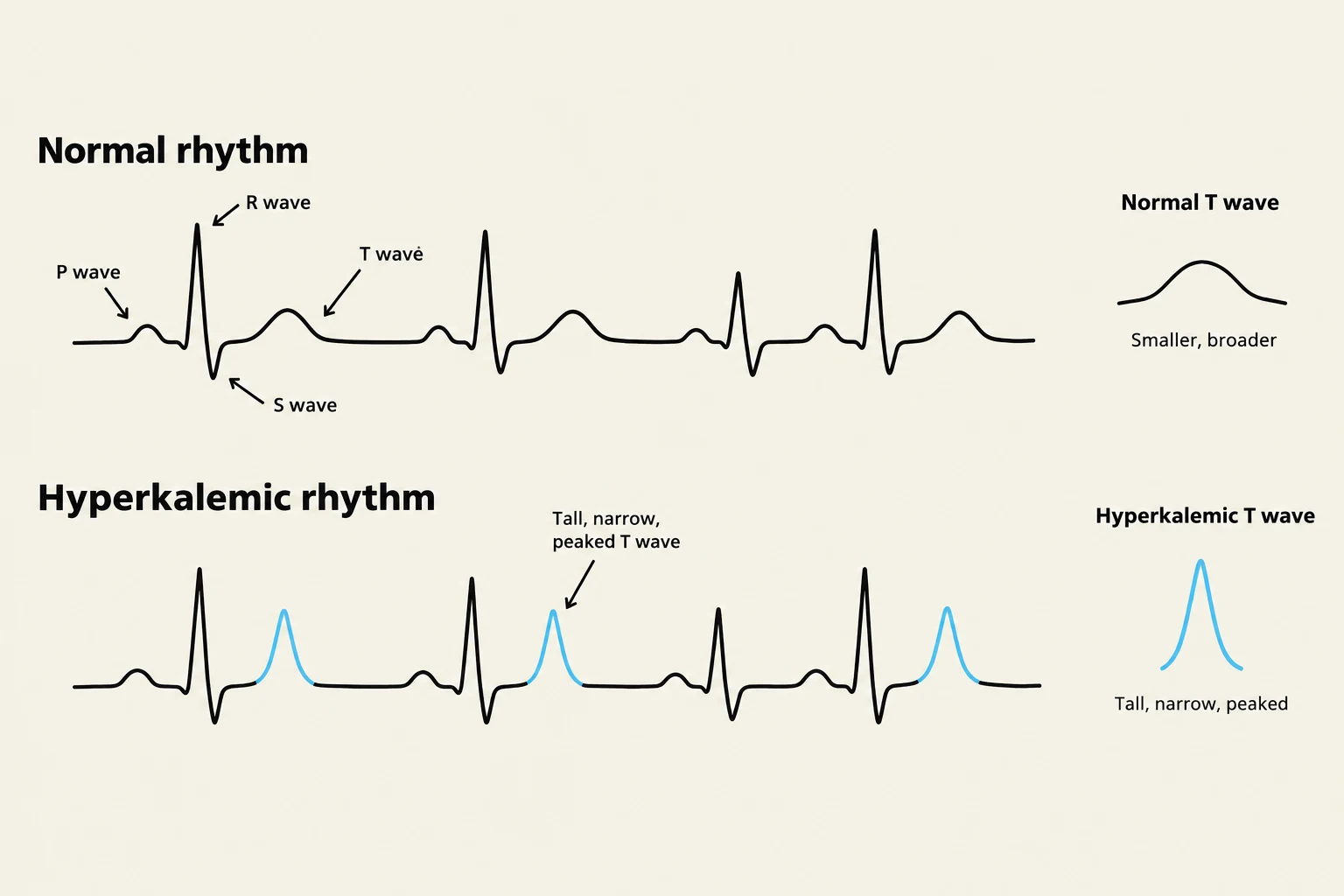 Comparison of normal and hyperkalemic electrocardiogram rhythms, highlighting differences in T wave morphology.