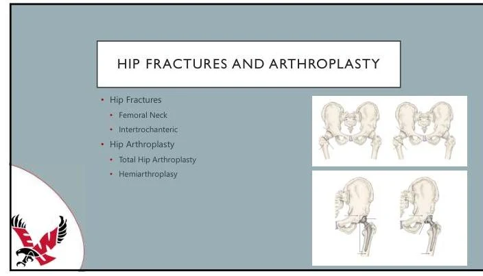 Diagrams illustrating hip fractures and arthroplasty procedures, including different types of hip fractures and surgical interventions like total hip and hemiarthroplasty.