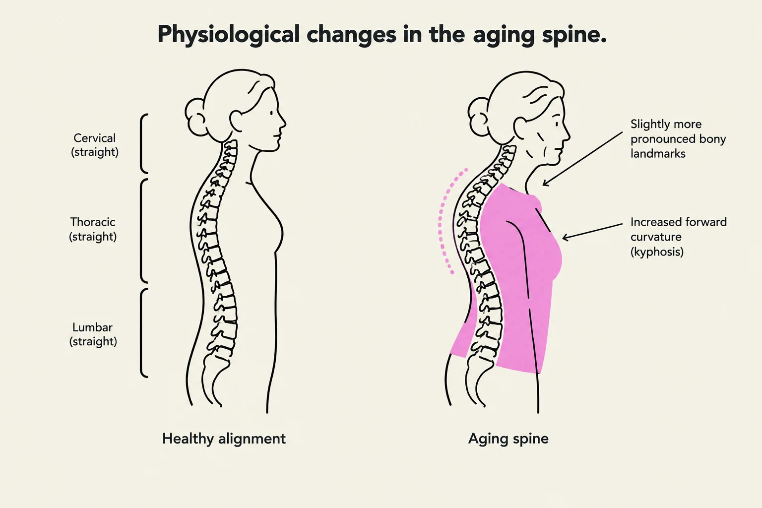 This illustration compares the spinal alignment of a healthy individual with that of an aging spine, highlighting increased forward curvature (kyphosis) and more pronounced bony landmarks.