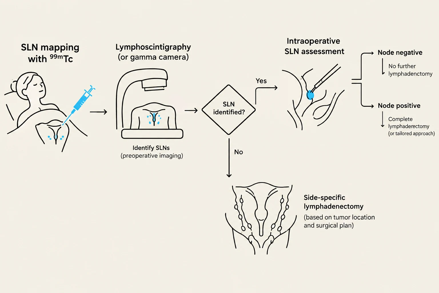 This diagram illustrates the process of sentinel lymph node (SLN) mapping and assessment, including preoperative imaging, intraoperative evaluation, and subsequent treatment decisions based on whether the SLN is identified as positive or negative for cancer cells.