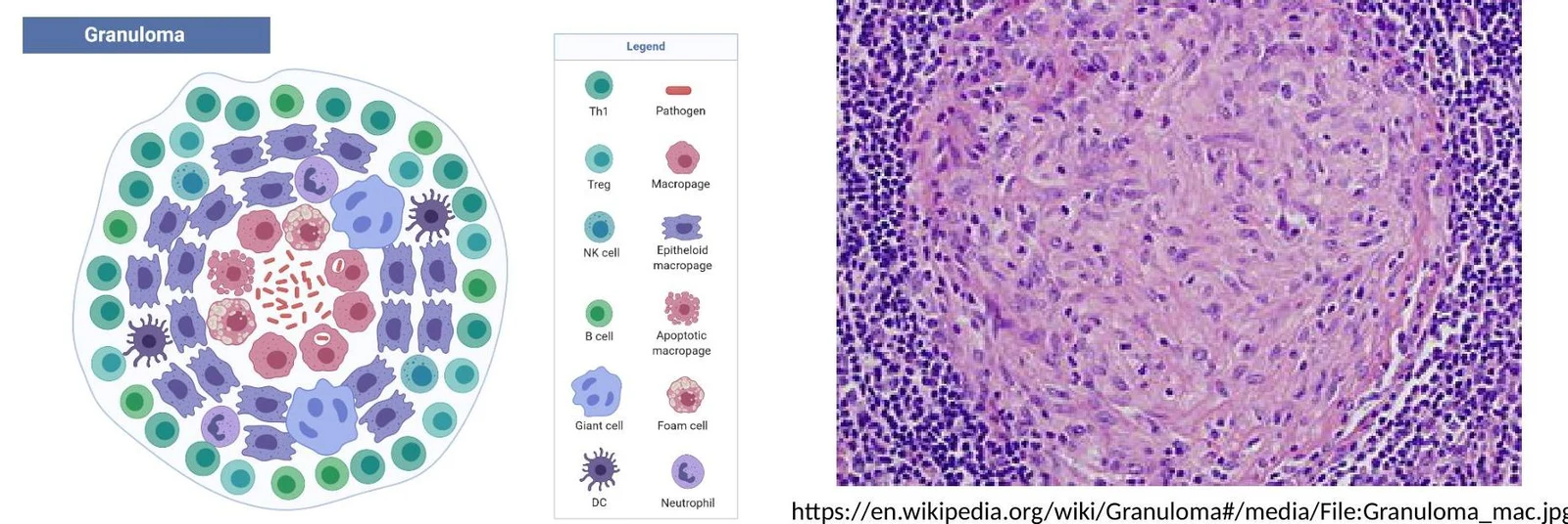 Diagram and micrograph illustrating the cellular composition of a granuloma, a type of inflammation.