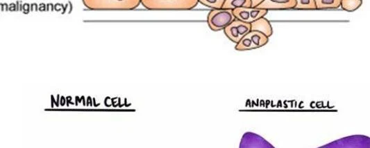 Comparison of normal cells and anaplastic cells, illustrating cellular changes associated with malignancy.
