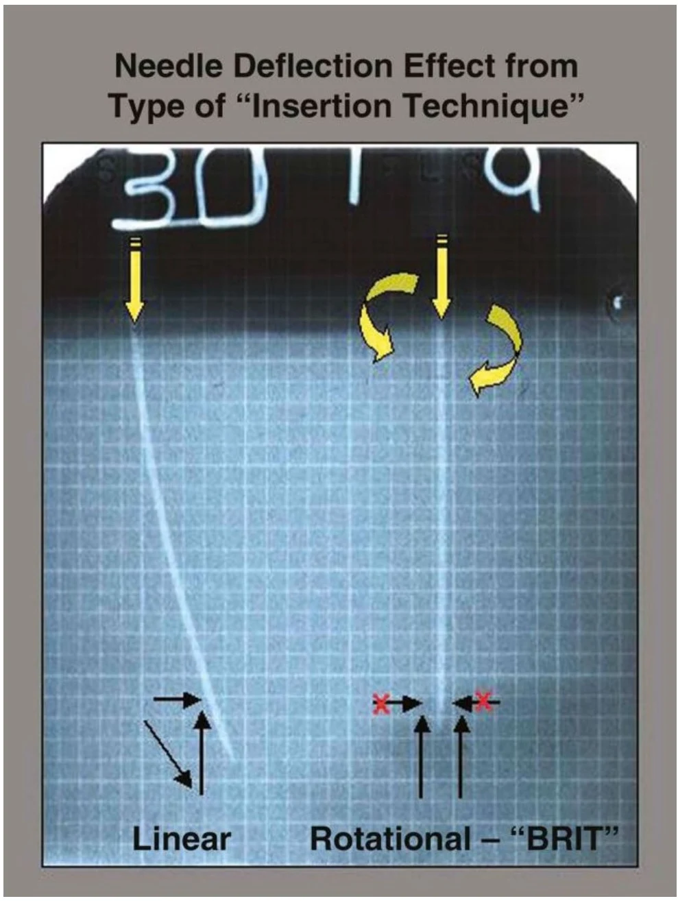 This image illustrates the needle deflection effect based on insertion technique, comparing linear and rotational (BRIT) methods.