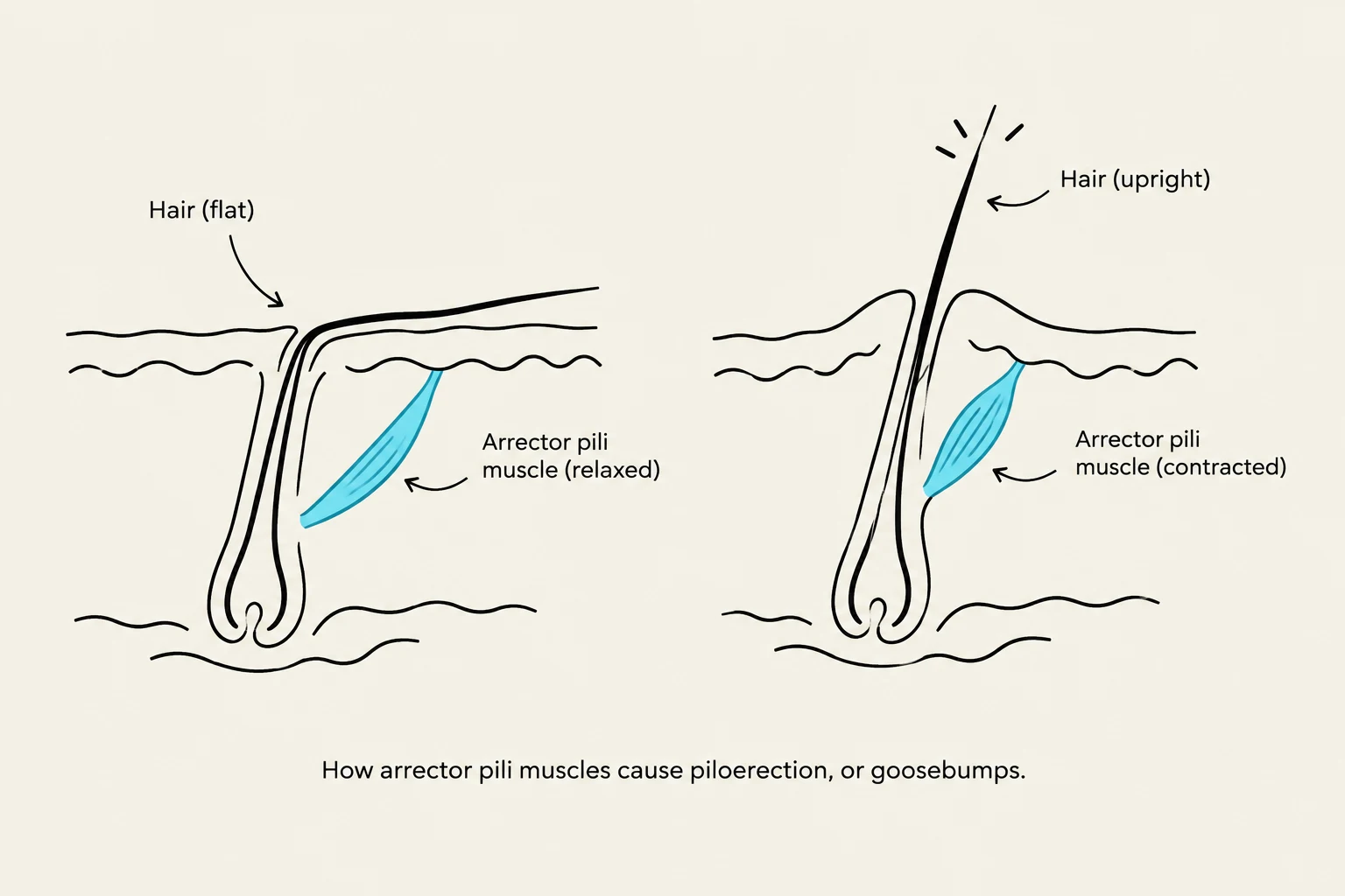 This diagram illustrates how the contraction of arrector pili muscles causes hairs to stand on end, resulting in goosebumps.
