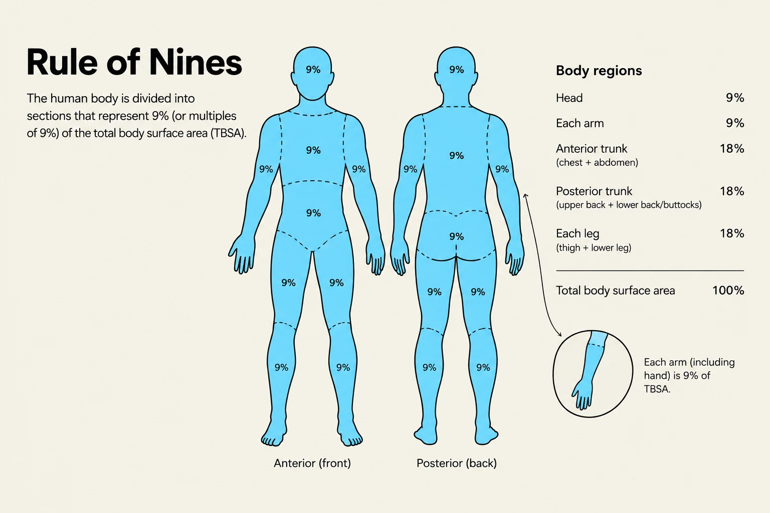 The Rule of Nines is a method used to assess the total surface area of burns on the human body. The body is divided into regions, each representing 9% or multiples of 9% of the total body surface area (TBSA).