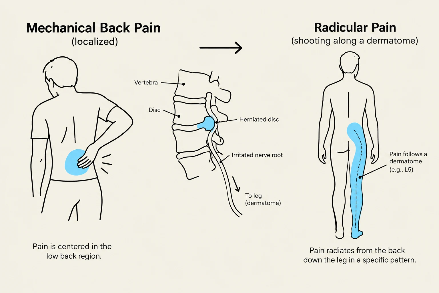 This illustration contrasts mechanical back pain, which is localized to the low back, with radicular pain, which shoots along a dermatome, often caused by a herniated disc irritating a nerve root.