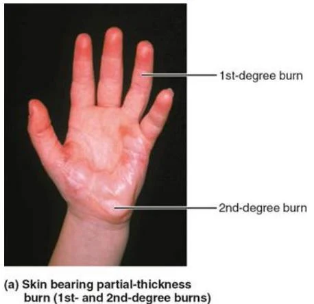 Illustration showing a hand with labels indicating areas affected by 1st-degree and 2nd-degree burns.