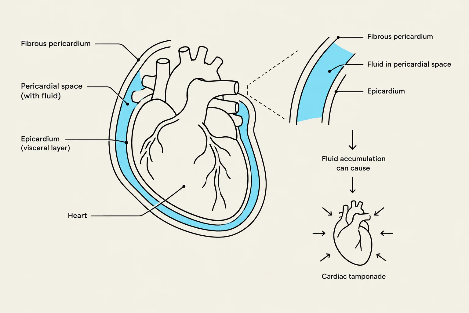 Diagram illustrating the pericardial space and its role in cardiac tamponade.