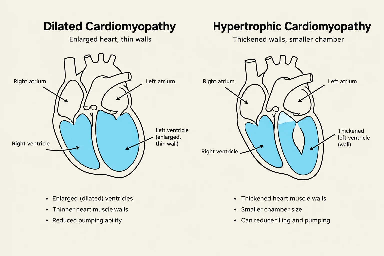 Diagrams illustrating the differences between Dilated Cardiomyopathy and Hypertrophic Cardiomyopathy, showing enlarged ventricles with thin walls in the former and thickened walls with a smaller chamber in the latter.