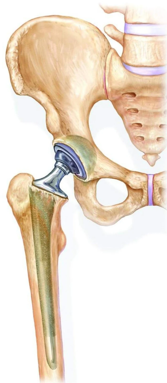 An illustration shows a hip prosthesis implanted in the pelvic bone and femur.