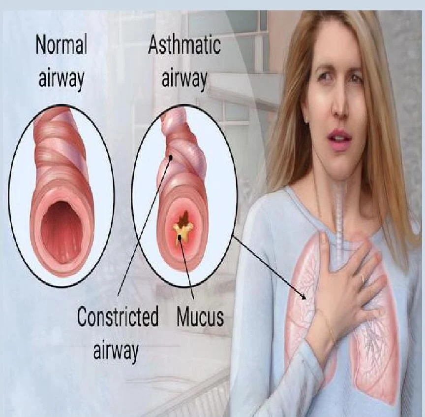 Illustration comparing a normal airway to an asthmatic airway, showing constriction and mucus buildup.