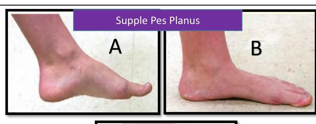 Comparison of a foot with supple pes planus (flat foot) labeled A and a foot with a normal arch labeled B.
