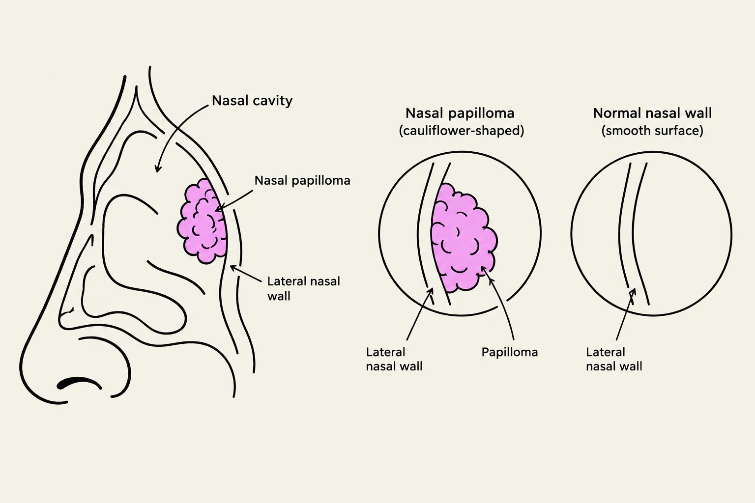 Diagram illustrating a nasal papilloma, a cauliflower-shaped growth on the lateral nasal wall, compared to a normal nasal wall.