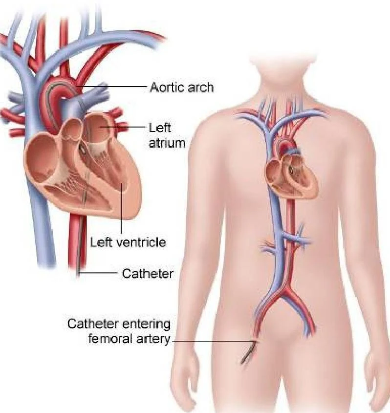 Diagram illustrating the path of a catheter entering the femoral artery and extending towards the heart, showing the aortic arch, left atrium, and left ventricle.
