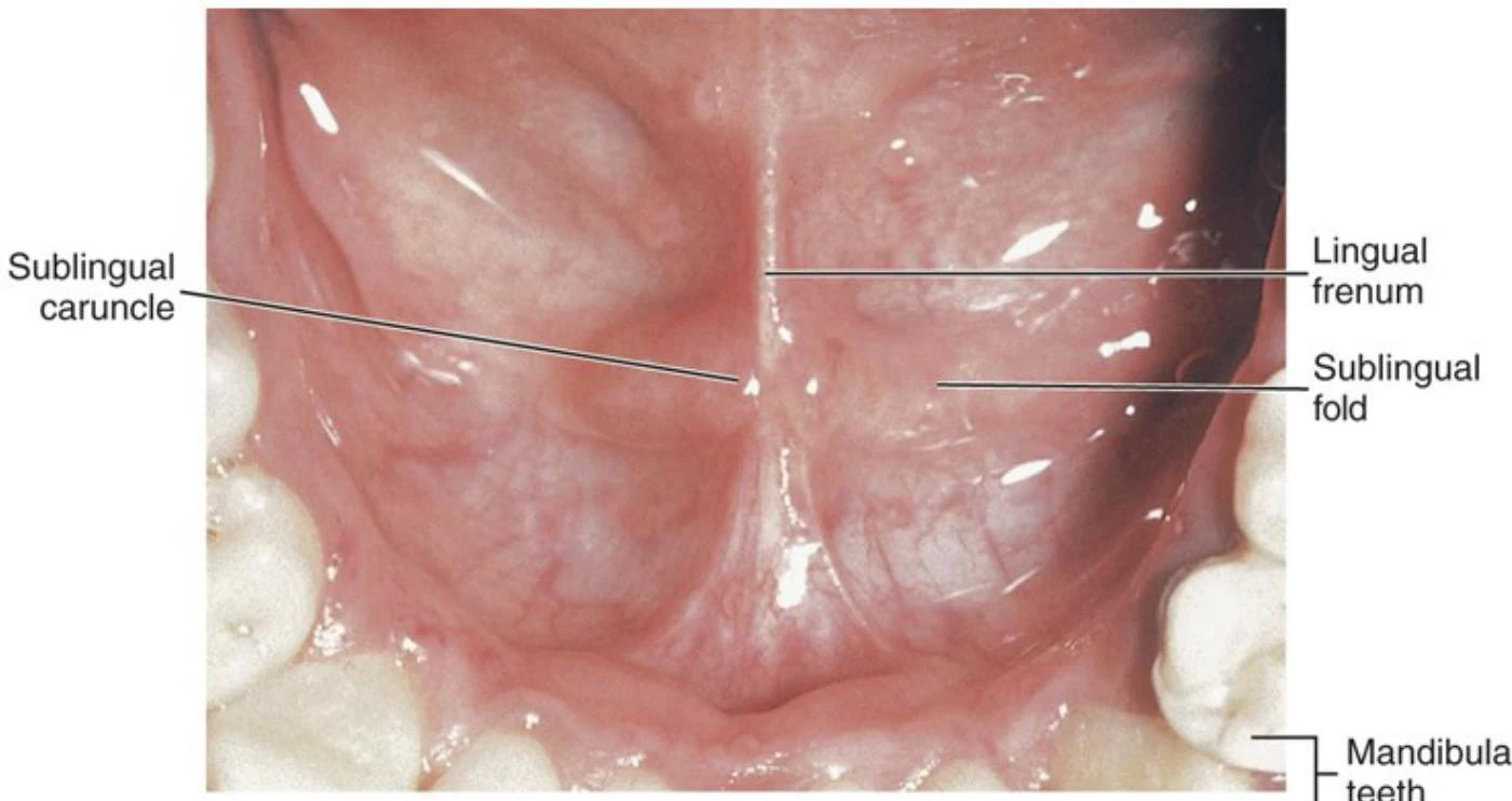 An anatomical illustration of the floor of the mouth, labeling the sublingual caruncle, lingual frenum, sublingual fold, and mandibular teeth.