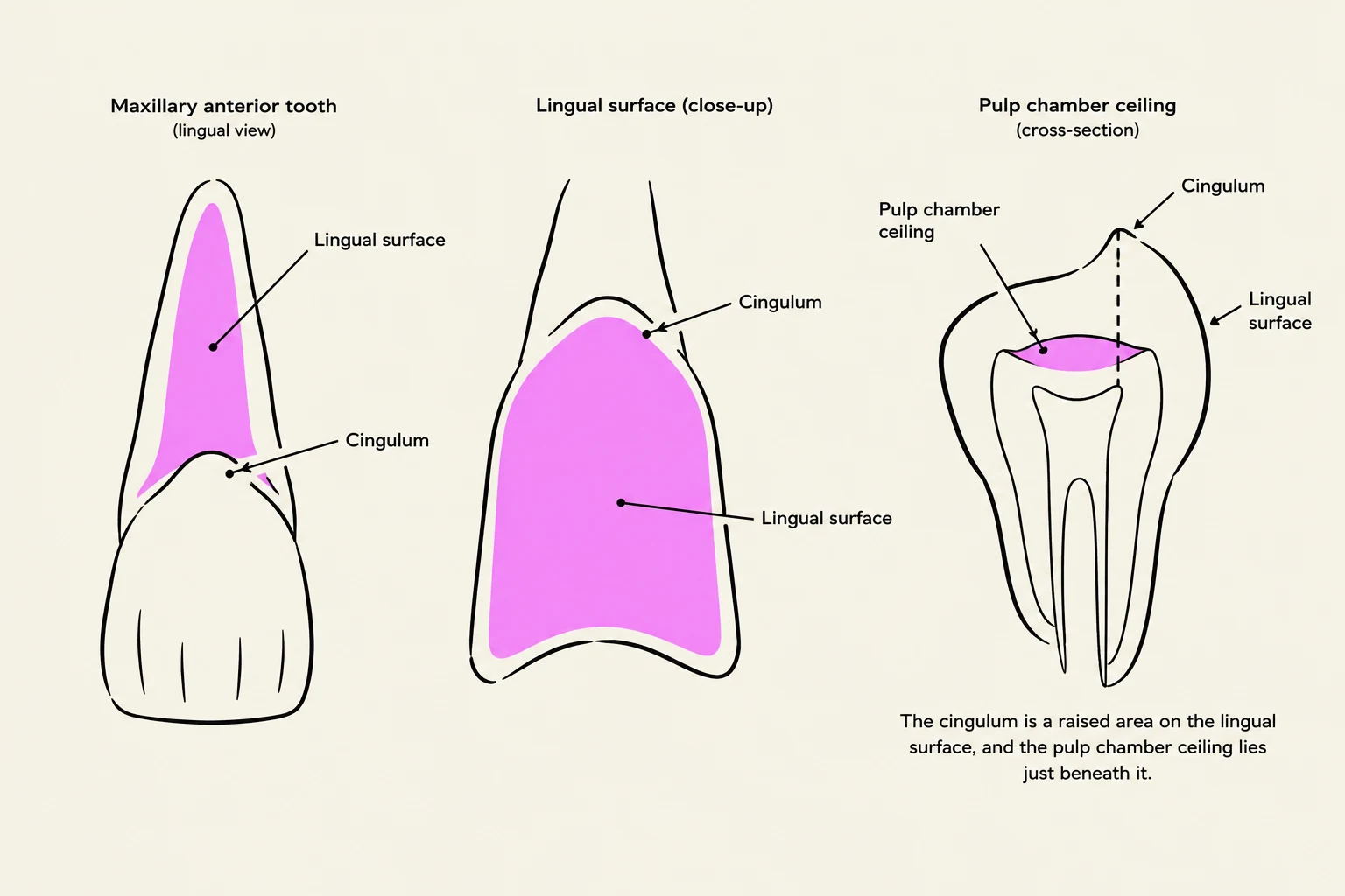 Diagrams illustrating the lingual surface and pulp chamber ceiling of a maxillary anterior tooth, with a description of the cingulum.