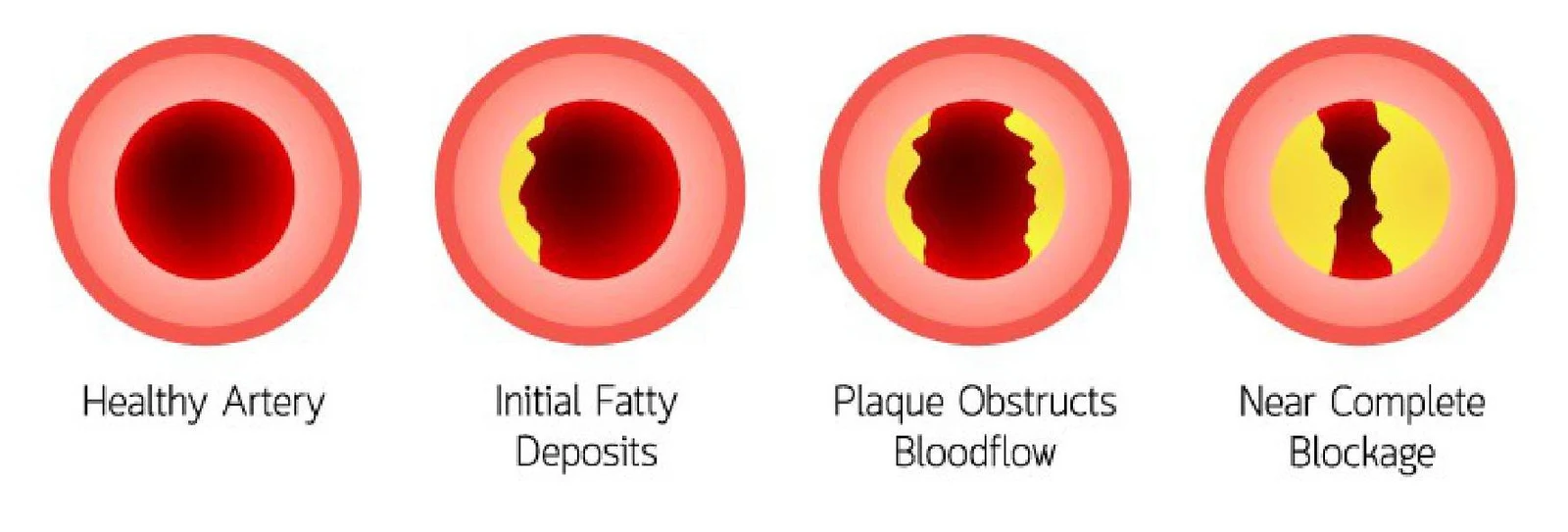Diagram illustrating the progression of atherosclerosis, from a healthy artery to near complete blockage due to plaque buildup.