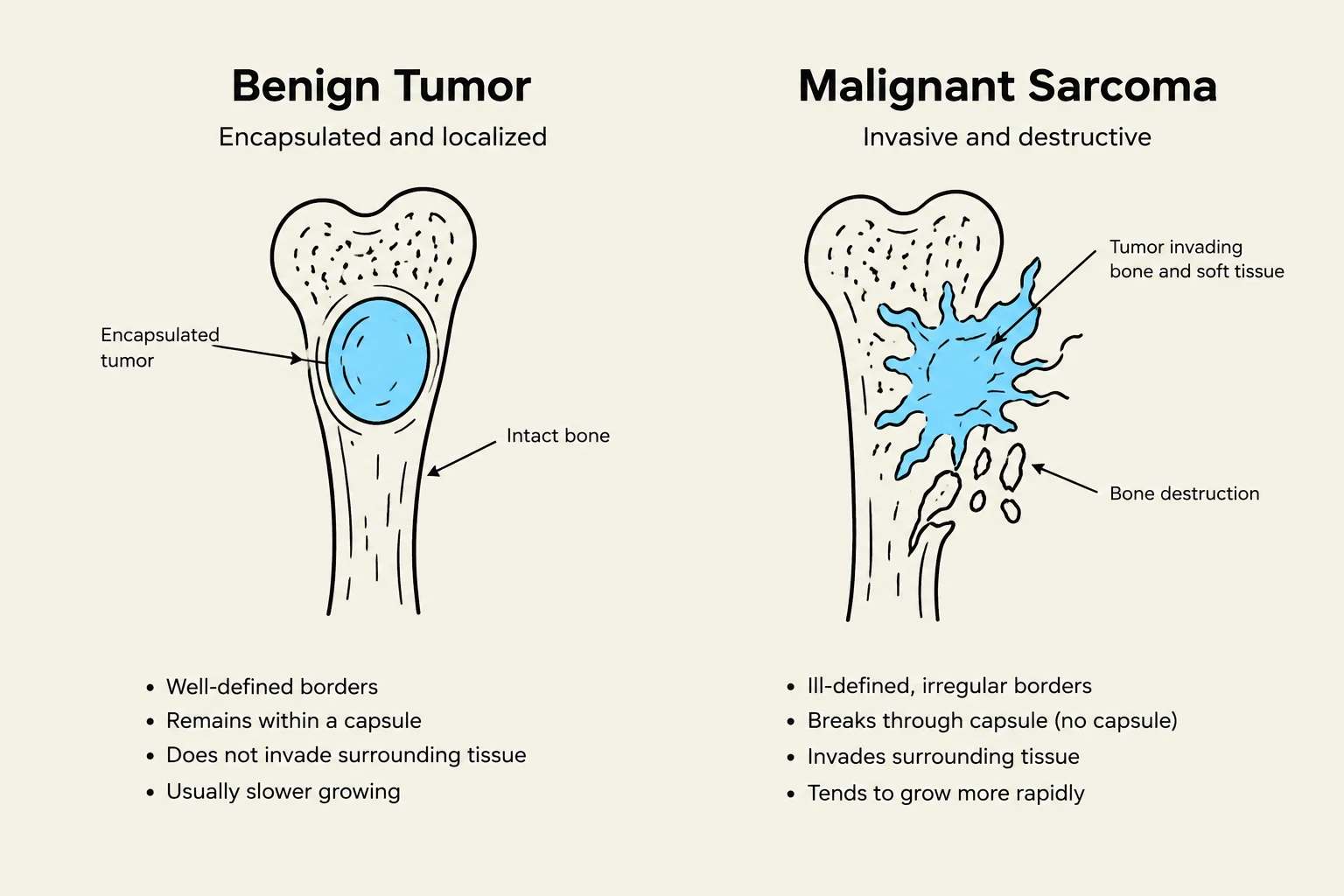 This illustration compares a benign tumor, which is encapsulated and localized, with a malignant sarcoma, which is invasive and destructive. It highlights key differences in their borders, invasiveness, and growth patterns.