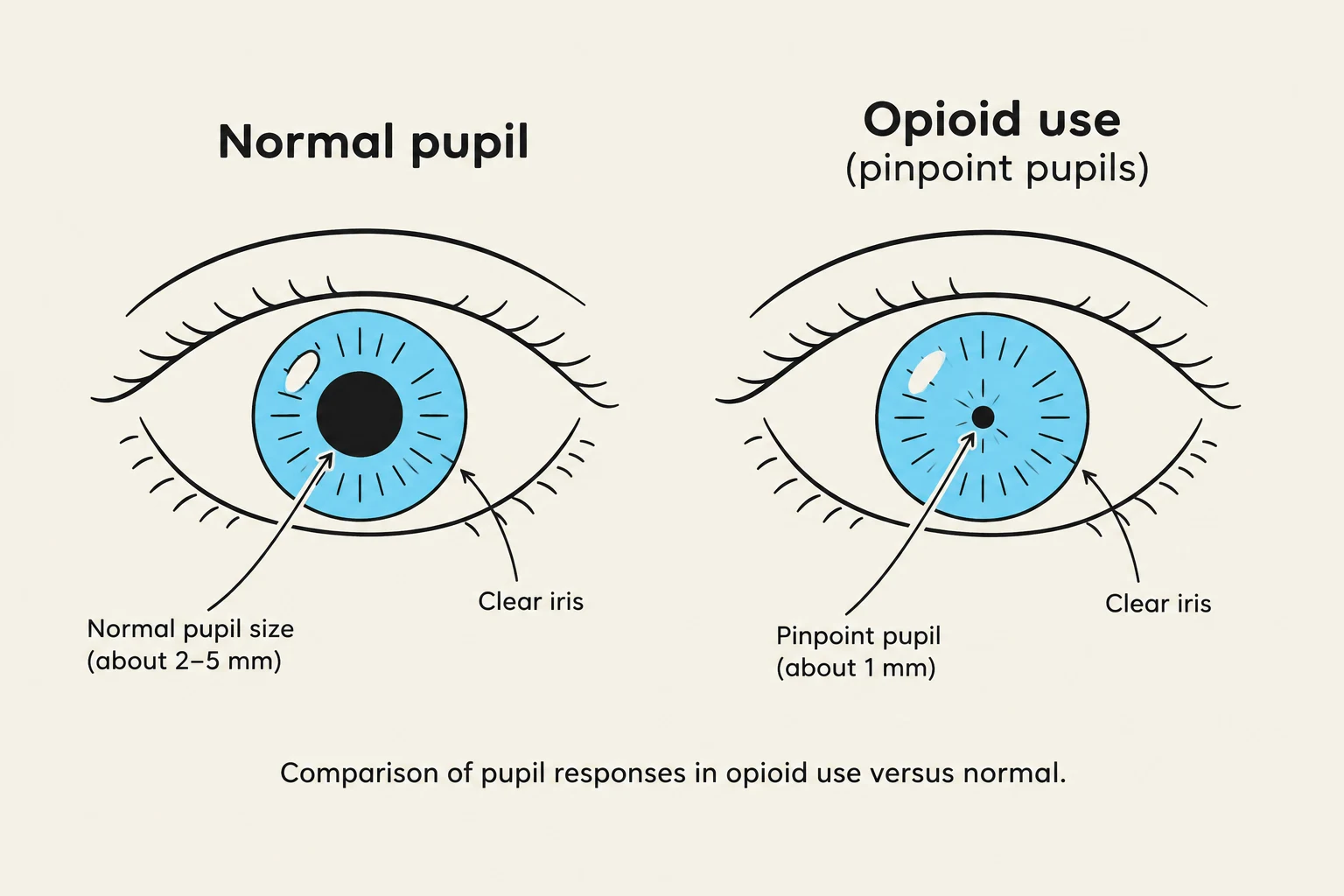 Comparison of pupil responses in opioid use versus normal.
