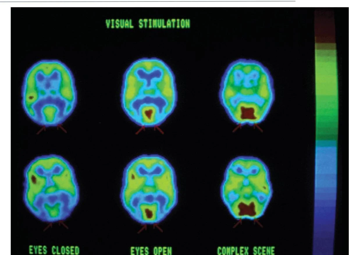 Brain activity scans under different visual stimulation conditions: eyes closed, eyes open, and viewing a complex scene.