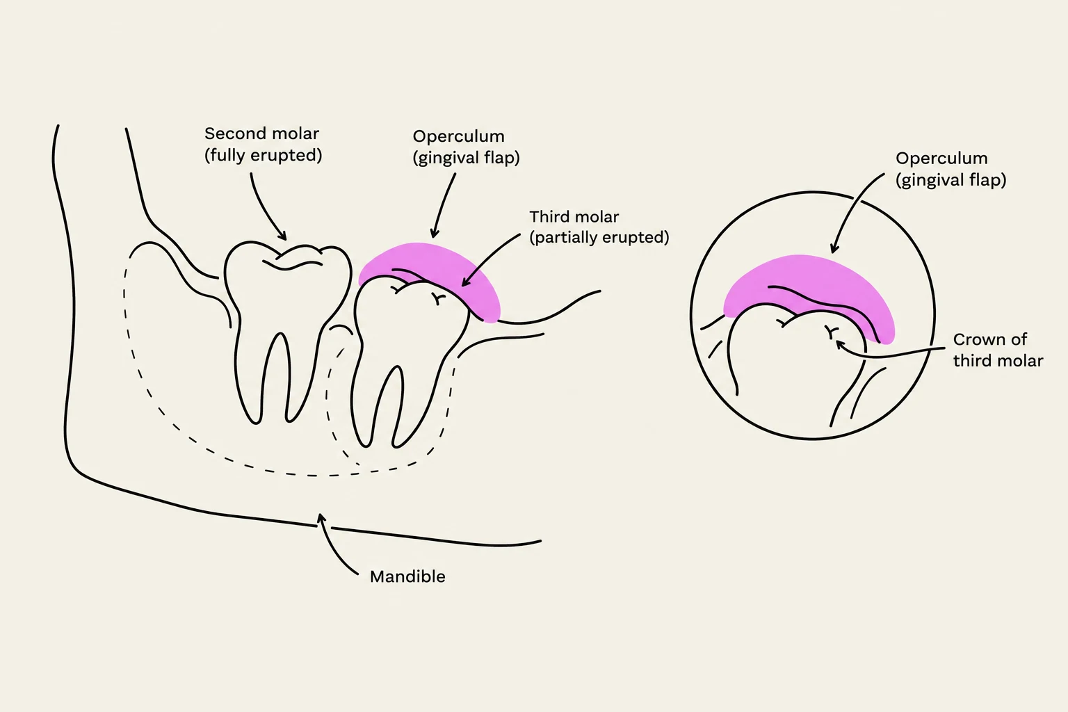 Diagram illustrating the anatomy of a partially erupted third molar and its relationship with the operculum and adjacent second molar within the mandible.