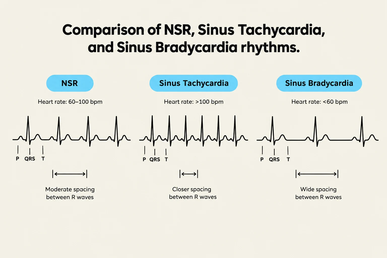Comparison of Normal Sinus Rhythm (NSR), Sinus Tachycardia, and Sinus Bradycardia rhythms, illustrating differences in heart rate and R-wave spacing on an electrocardiogram.