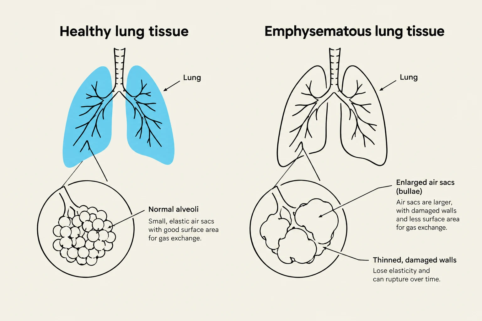 Comparison of healthy lung tissue with normal alveoli and emphysematous lung tissue showing enlarged air sacs (bullae) with thinned, damaged walls.