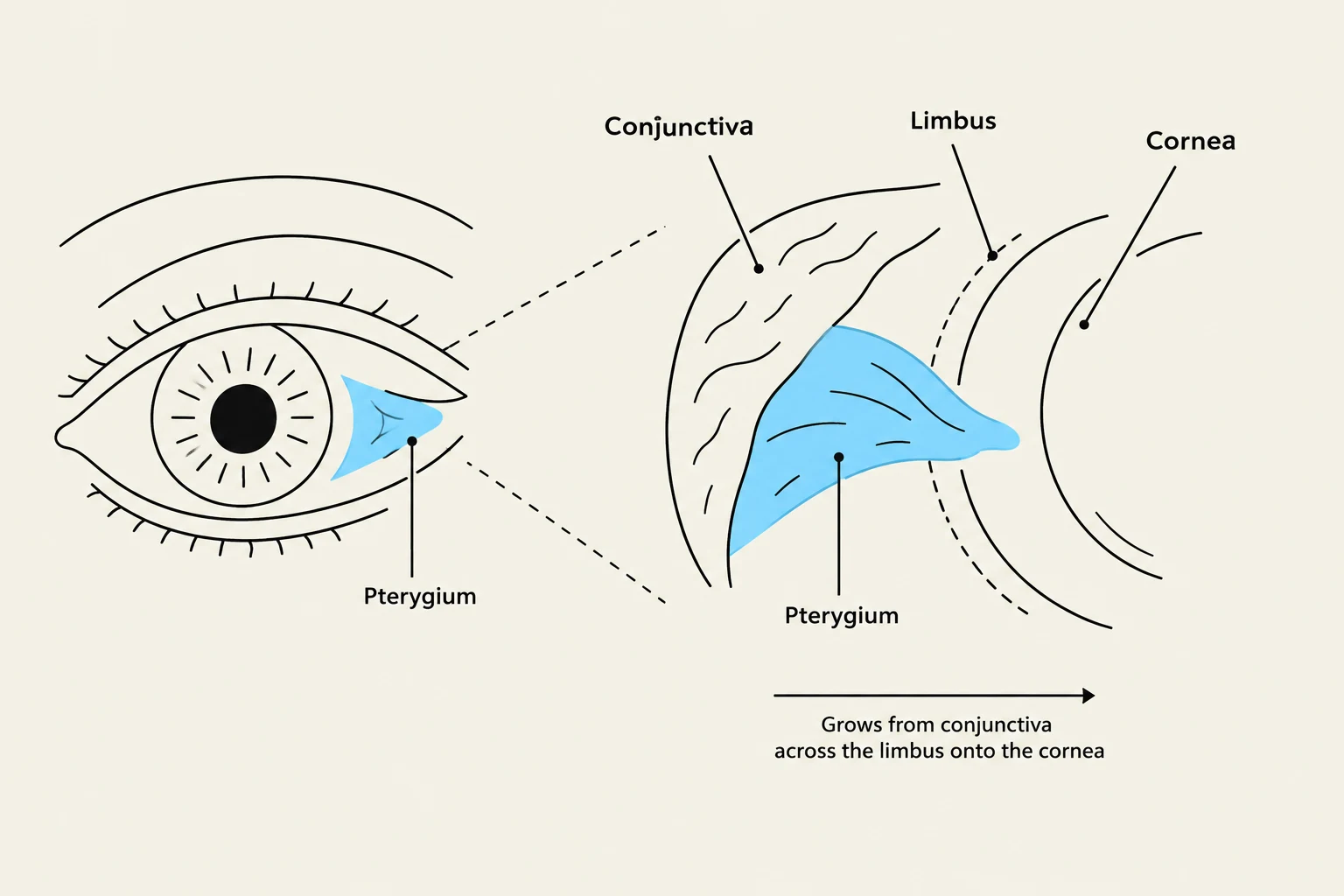 Diagram illustrating a pterygium, a growth from the conjunctiva onto the cornea of the eye.